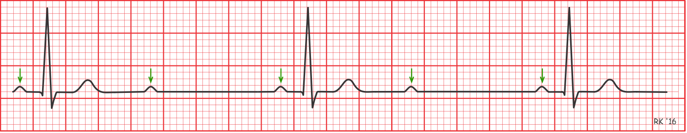 Second degree type 2 AV block
